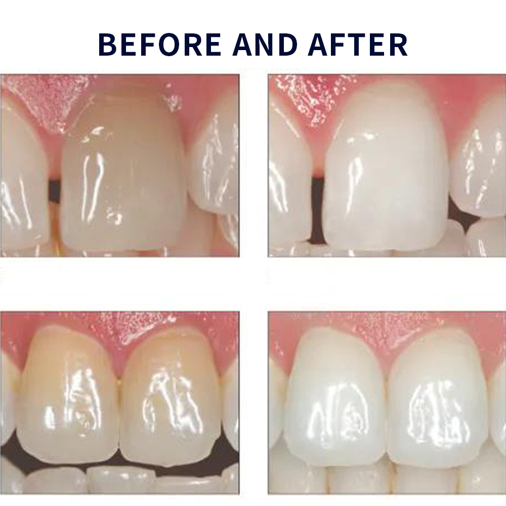 Opalescence Whitening 20% PF 2 - đánh giá và giá Teeth Whitening Ai