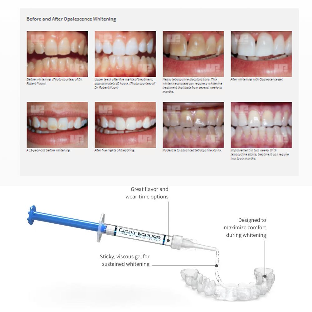 Opalescence Whitening 20% PF 2 - đánh giá và giá Teeth Whitening Ai