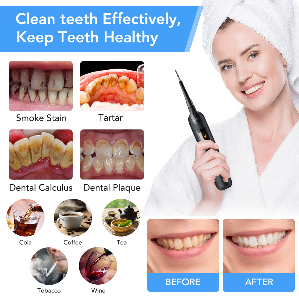 Teeth Tartar Remover Electric  - đánh giá và giá Teeth Whitening From Home