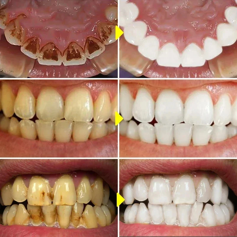 Teeth Whitening Toothpaste Fru - đánh giá và giá Teeth Whitening Xylitol