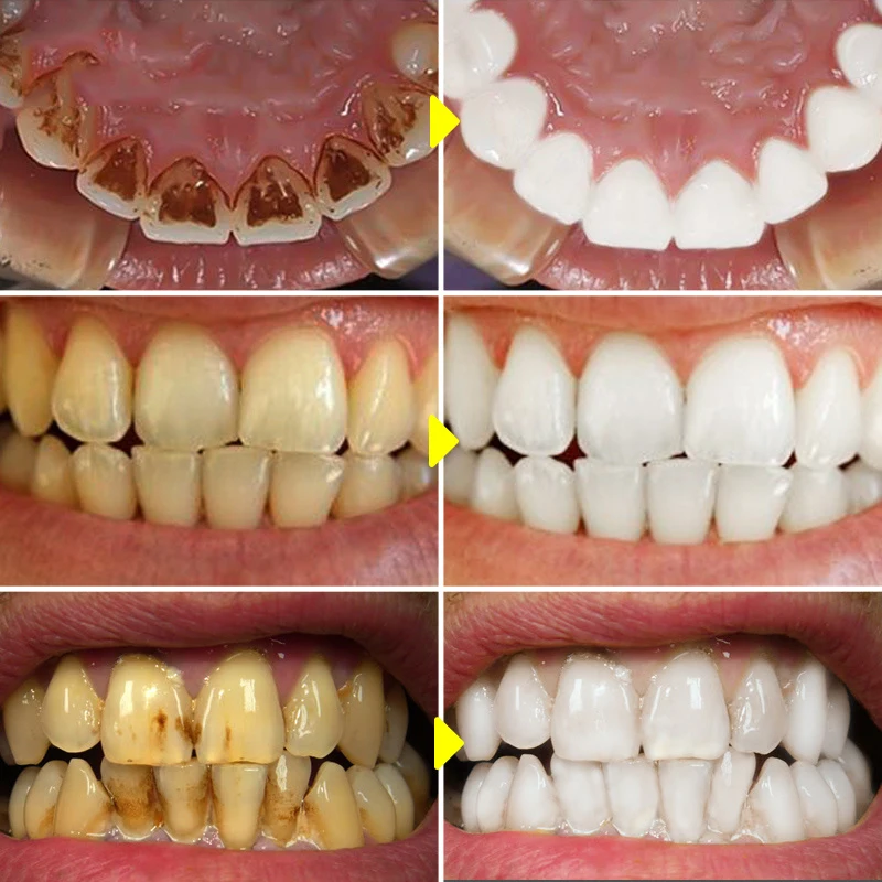 V34 Teeth Whitening Mousse Too - đánh giá và giá Teeth Whitening Xylitol