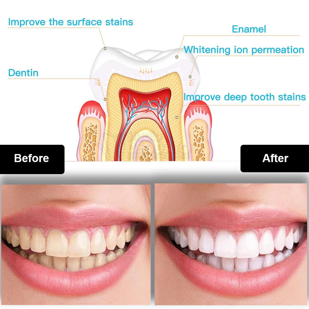 Dental Teeth Whitening Kit Min - đánh giá và giá Teeth Whitening From Home